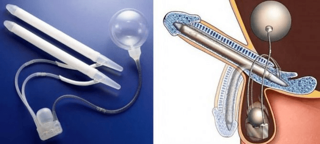 phalloprosthetics for penis enlargement