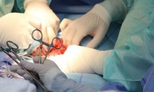 the penis enlargement surgery